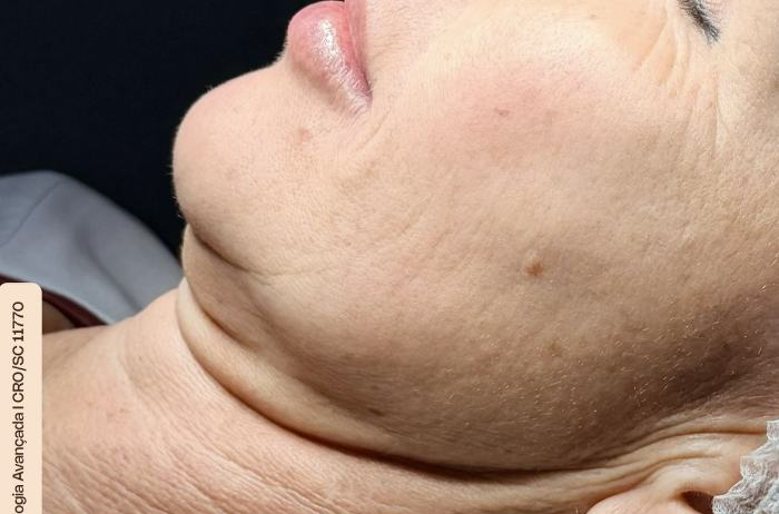 Resultado — Dra. Aline Esmeraldino | E.Clinic Orofacial